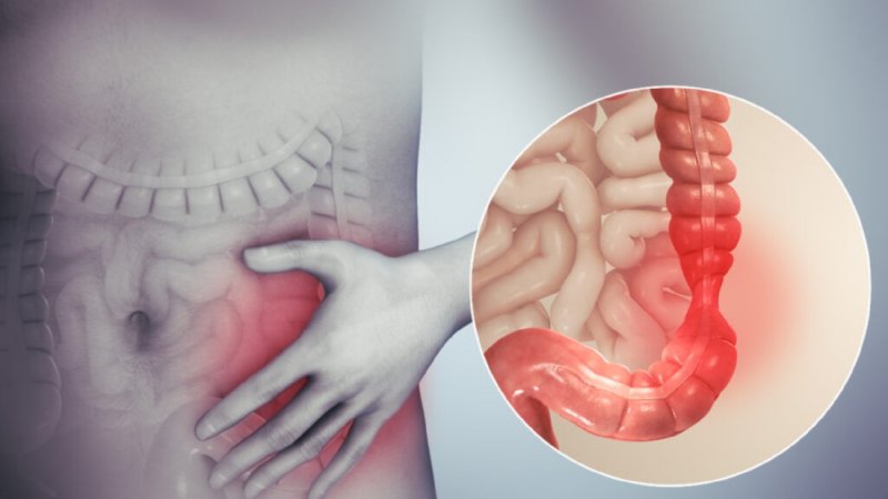 Ulaş Utku Bozdoğan: ibs duzensiz bagirsak sendromu nedir wD5GqBZh